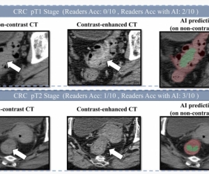 ​阿里巴巴发布创新癌症AI模型 助力肠癌筛查
