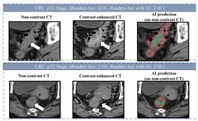 ​阿里巴巴发布创新癌症AI模型 助力肠癌筛查